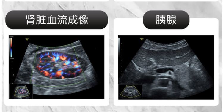 新玛彩超仪器全数字彩色推车款体检仪